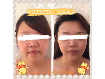 やはり、小顔になりたい方にお客様の悩みは戻りました