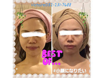 顔の浮腫は絶対に、放置しないでください！！！